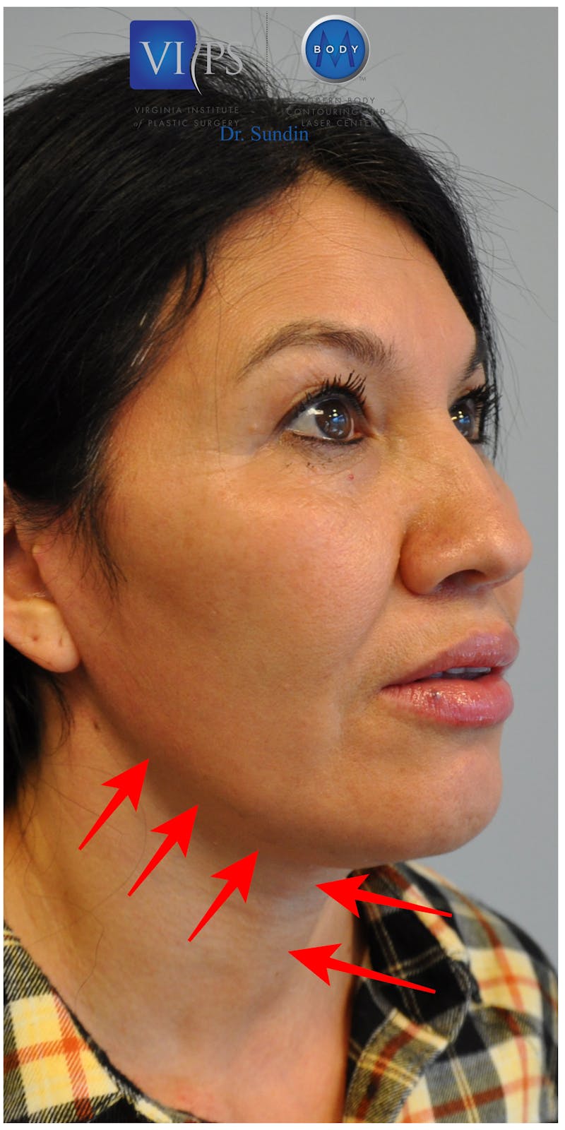 Facelift Before & After Gallery - Patient 110235562 - Image 8