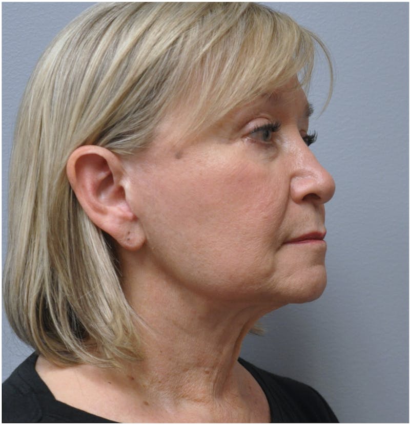 Facelift Before & After Gallery - Patient 110235561 - Image 3