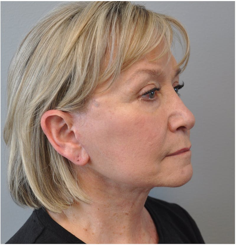 Facelift Before & After Gallery - Patient 110235561 - Image 4
