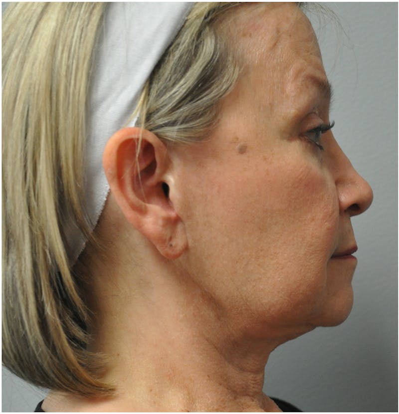 Neck Lift Before & After Gallery - Patient 110235564 - Image 1