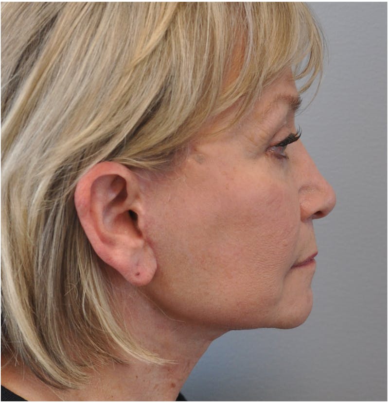 Facelift Before & After Gallery - Patient 110235561 - Image 6
