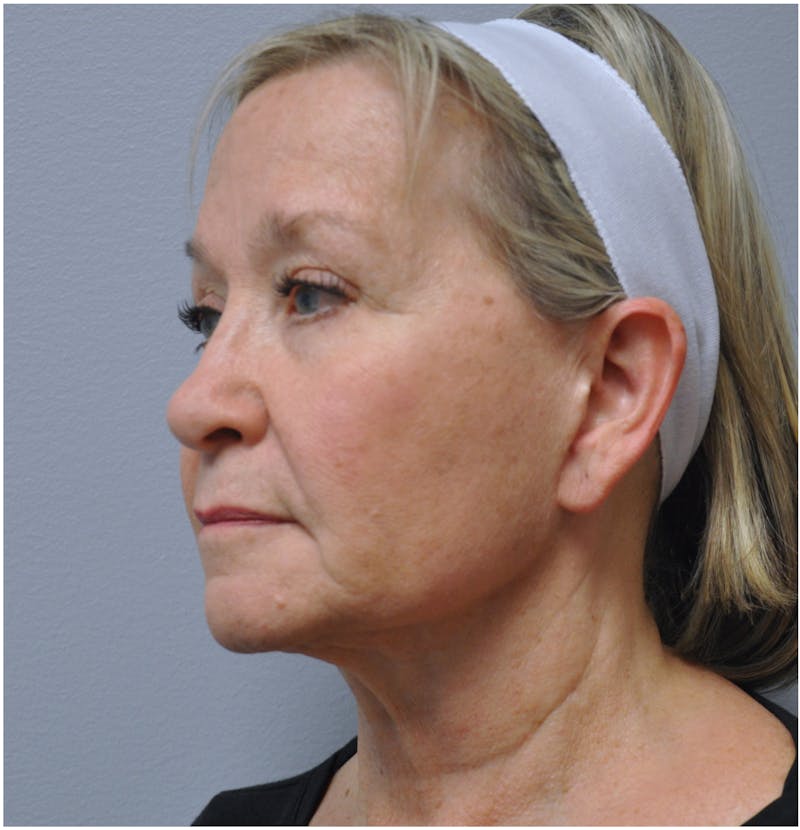Facelift Before & After Gallery - Patient 110235561 - Image 7