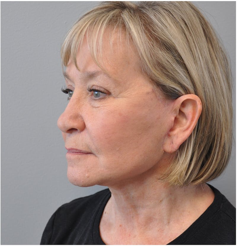 Facelift Before & After Gallery - Patient 110235561 - Image 8