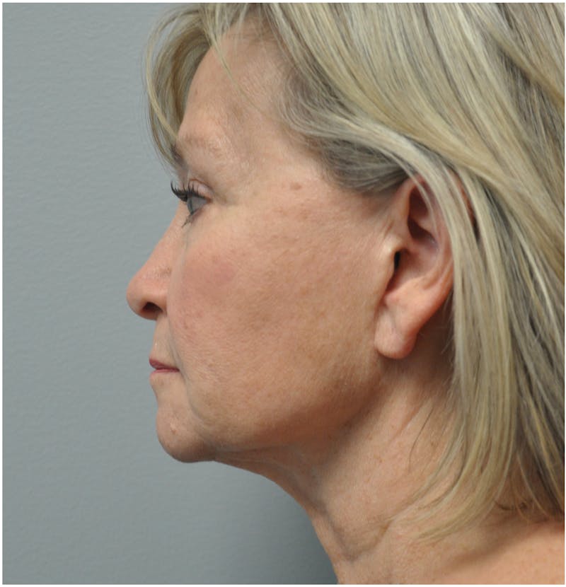 Facelift Before & After Gallery - Patient 110235561 - Image 9