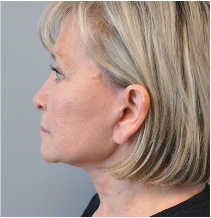 Facelift Before & After Gallery - Patient 110235561 - Image 10