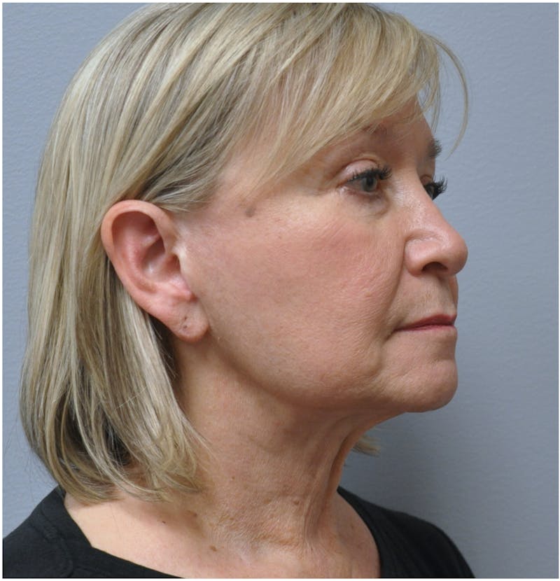 Facelift Before & After Gallery - Patient 110235561 - Image 11