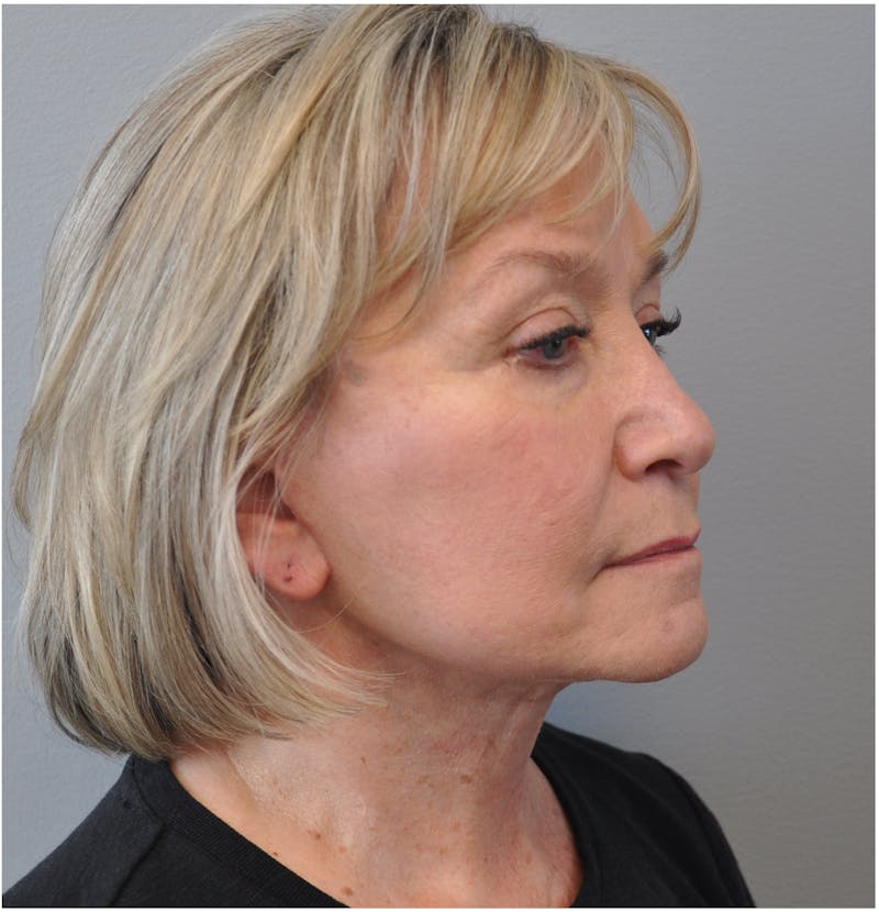 Facelift Before & After Gallery - Patient 110235561 - Image 12