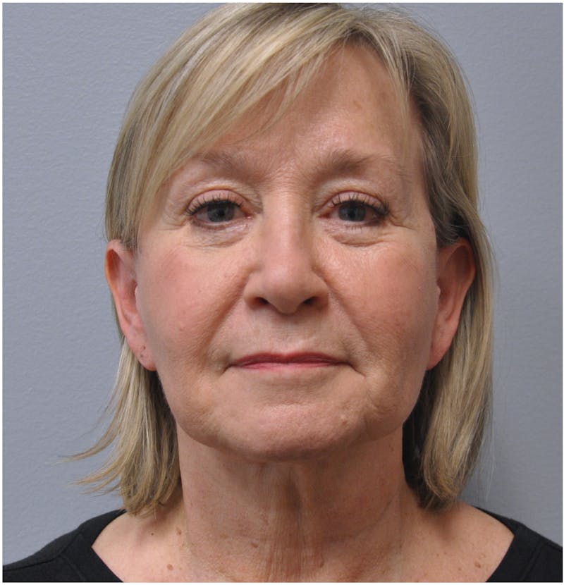 Neck Lift Before & After Gallery - Patient 110235564 - Image 3