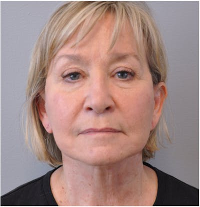 Facelift Before & After Gallery - Patient 110235561 - Image 2