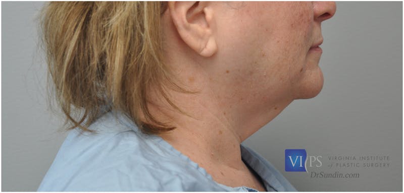 Facelift Before & After Gallery - Patient 110235563 - Image 3