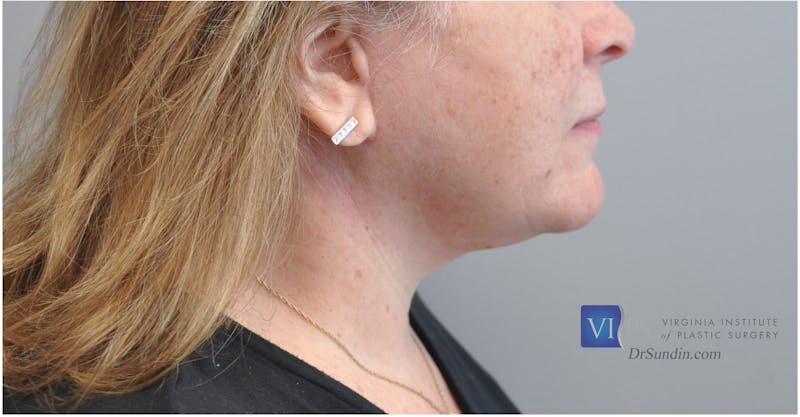 Neck Lift Before & After Gallery - Patient 110235567 - Image 4