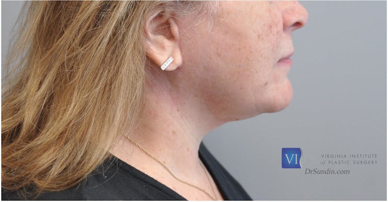 Facelift Before & After Gallery - Patient 110235563 - Image 4