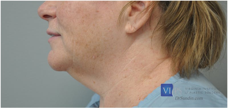 Neck Lift Before & After Gallery - Patient 110235567 - Image 5