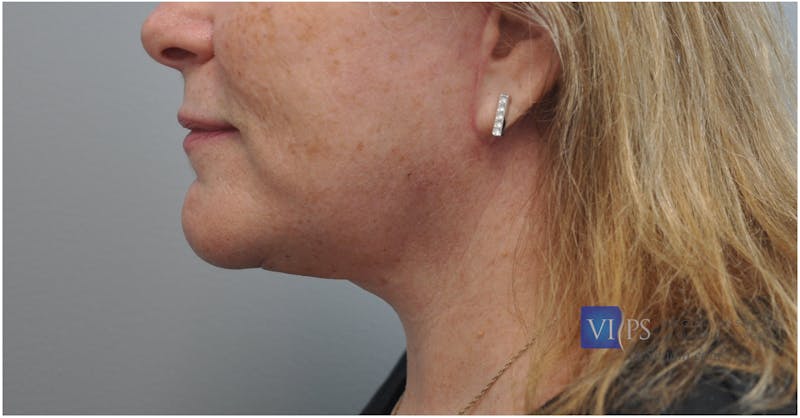 Facelift Before & After Gallery - Patient 110235563 - Image 6
