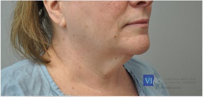 Facelift Before & After Gallery - Patient 110235563 - Image 1