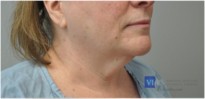 Neck Lift Before & After Gallery - Patient 110235567 - Image 1