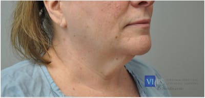 Neck Lift Before & After Gallery - Patient 110235567 - Image 1