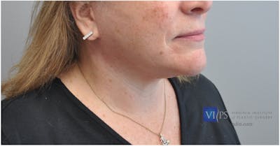 Facelift Before & After Gallery - Patient 110235563 - Image 2