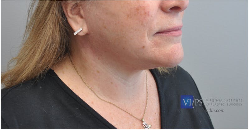 Neck Lift Before & After Gallery - Patient 110235567 - Image 2
