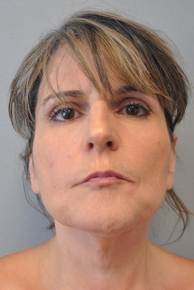 Facelift Before & After Gallery - Patient 177616855 - Image 1