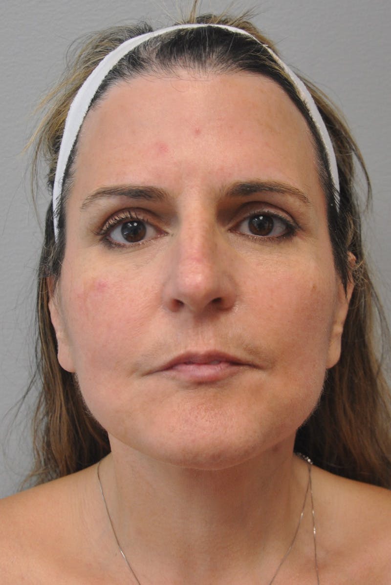 Facelift Before & After Gallery - Patient 177616855 - Image 2