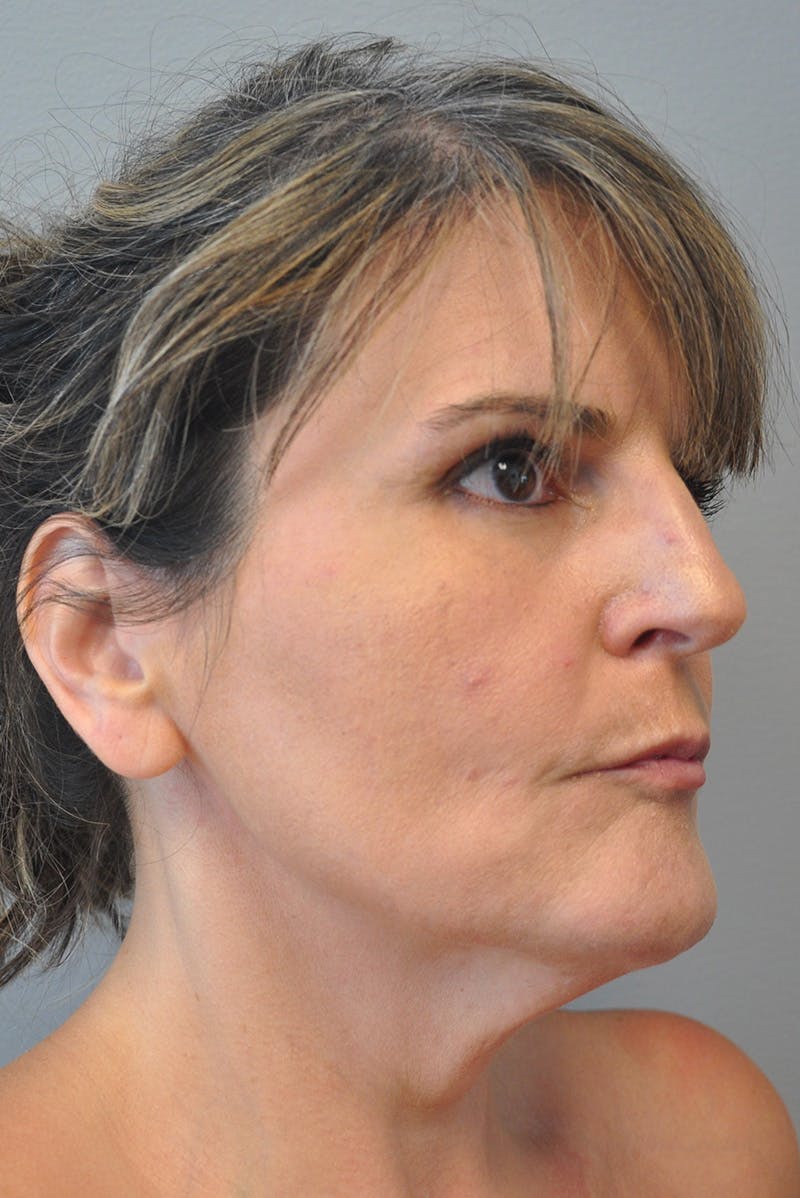 Facelift Before & After Gallery - Patient 177616855 - Image 3