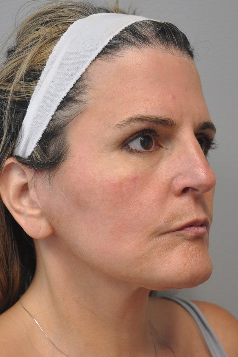 Facelift Before & After Gallery - Patient 177616855 - Image 4