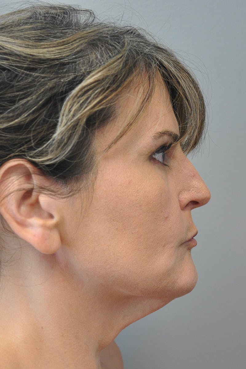Facelift Before & After Gallery - Patient 177616855 - Image 5
