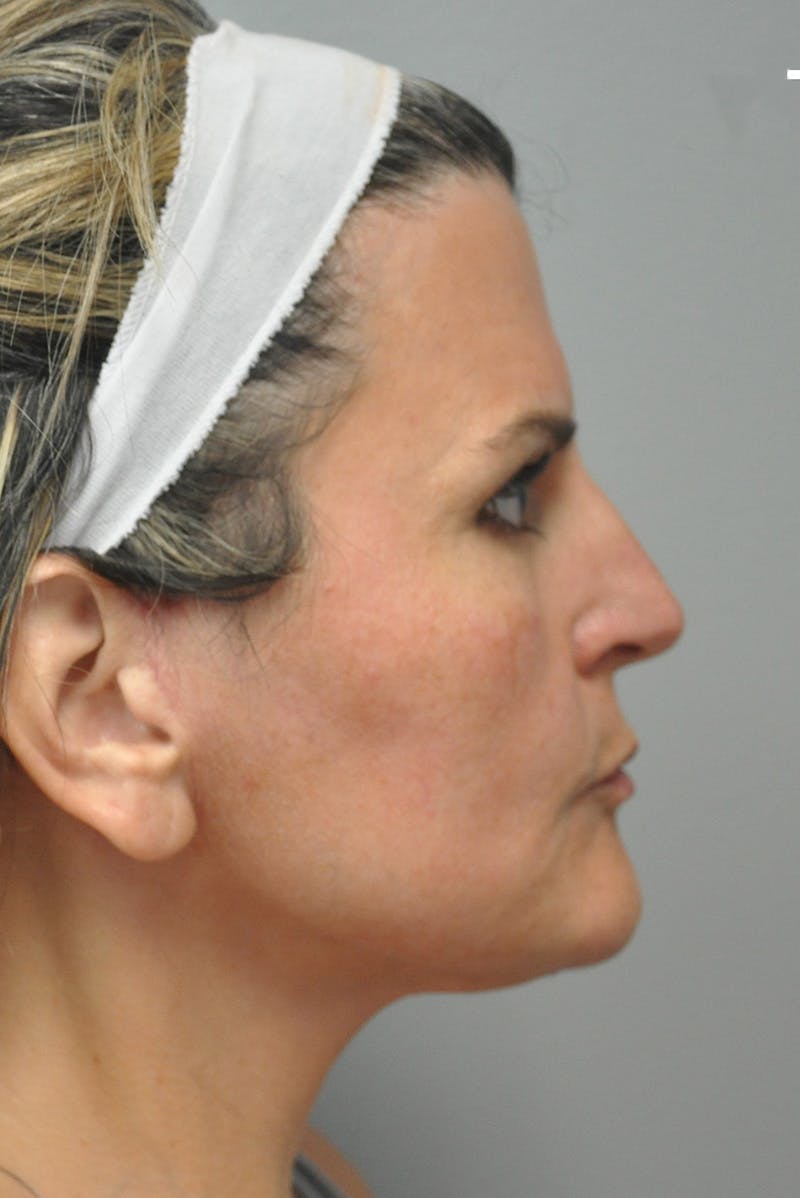 Facelift Before & After Gallery - Patient 177616855 - Image 6