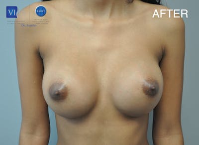 Breast Augmentation Before & After Gallery - Patient 177616988 - Image 2