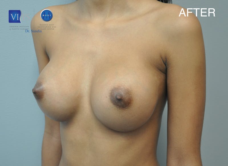 Breast Augmentation Before & After Gallery - Patient 177616988 - Image 4