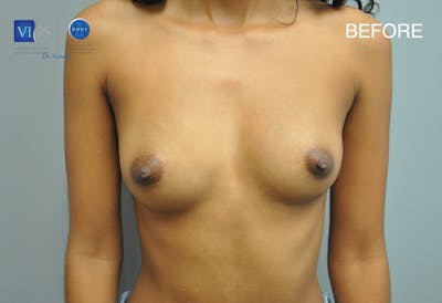 Breast Augmentation Before & After Gallery - Patient 177616988 - Image 1