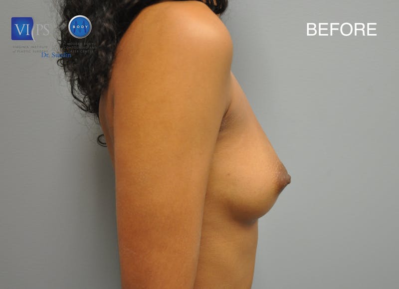 Breast Augmentation Before & After Gallery - Patient 177616988 - Image 5