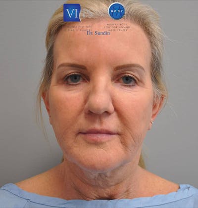 Facelift Before & After Gallery - Patient 201181557 - Image 1