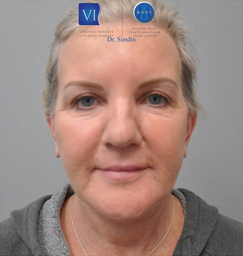 Neck Lift Before & After Gallery - Patient 201181562 - Image 10