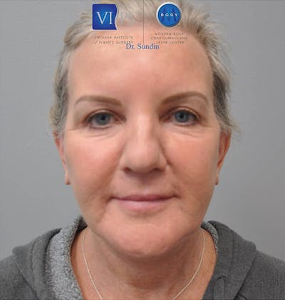 Facelift Before & After Gallery - Patient 201181557 - Image 2