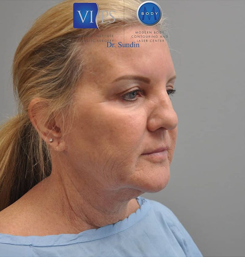 Facelift Before & After Gallery - Patient 201181557 - Image 3