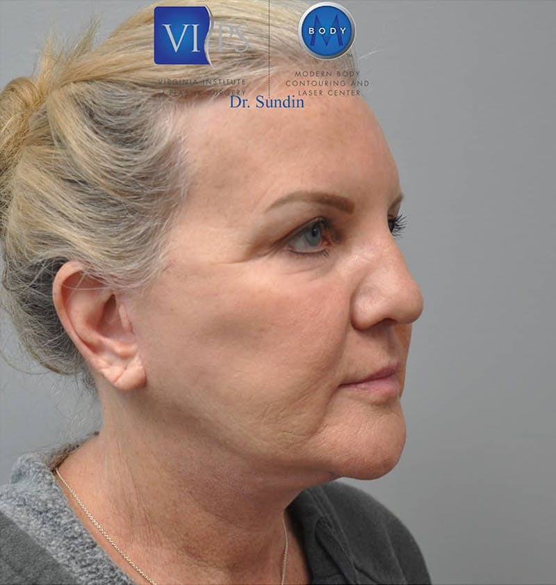 Neck Lift Before & After Gallery - Patient 201181562 - Image 2