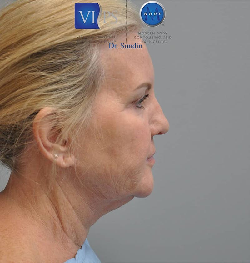 Neck Lift Before & After Gallery - Patient 201181562 - Image 3