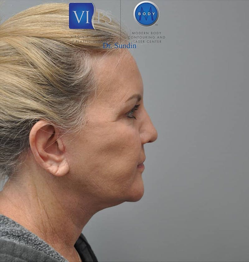 Neck Lift Before & After Gallery - Patient 201181562 - Image 4