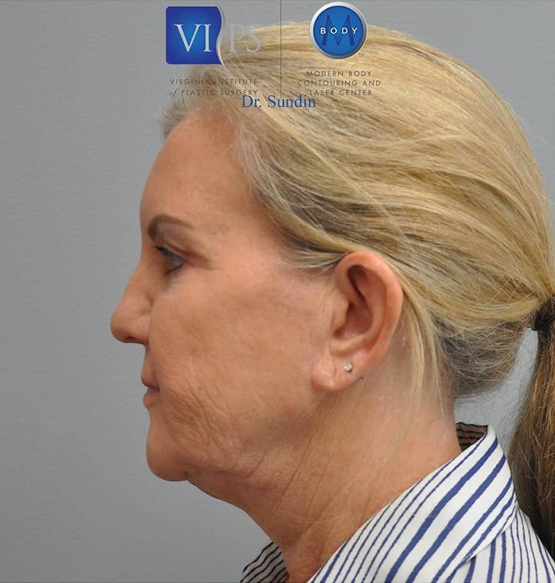 Facelift Before & After Gallery - Patient 201181557 - Image 7