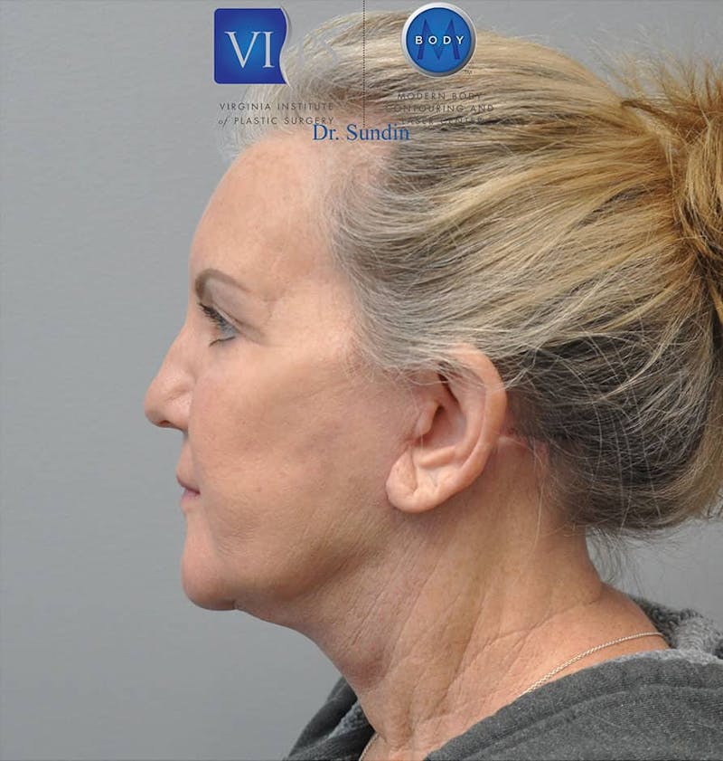 Facelift Before & After Gallery - Patient 201181557 - Image 8
