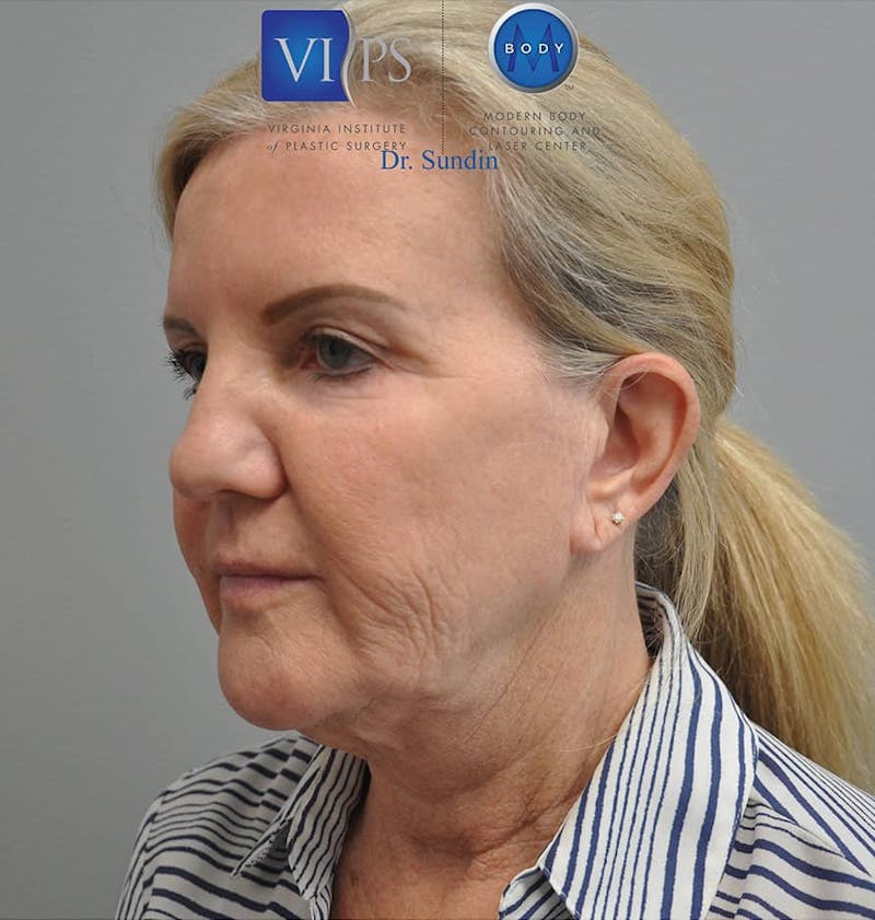 Neck Lift Before & After Gallery - Patient 201181562 - Image 7