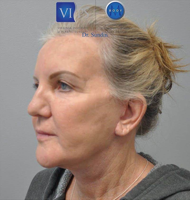 Neck Lift Before & After Gallery - Patient 201181562 - Image 8