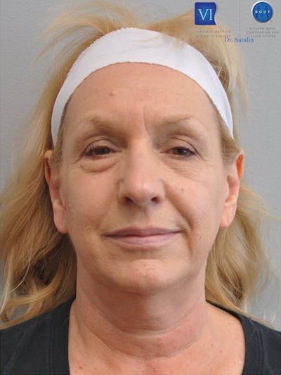 Facelift Before & After Gallery - Patient 201181556 - Image 1