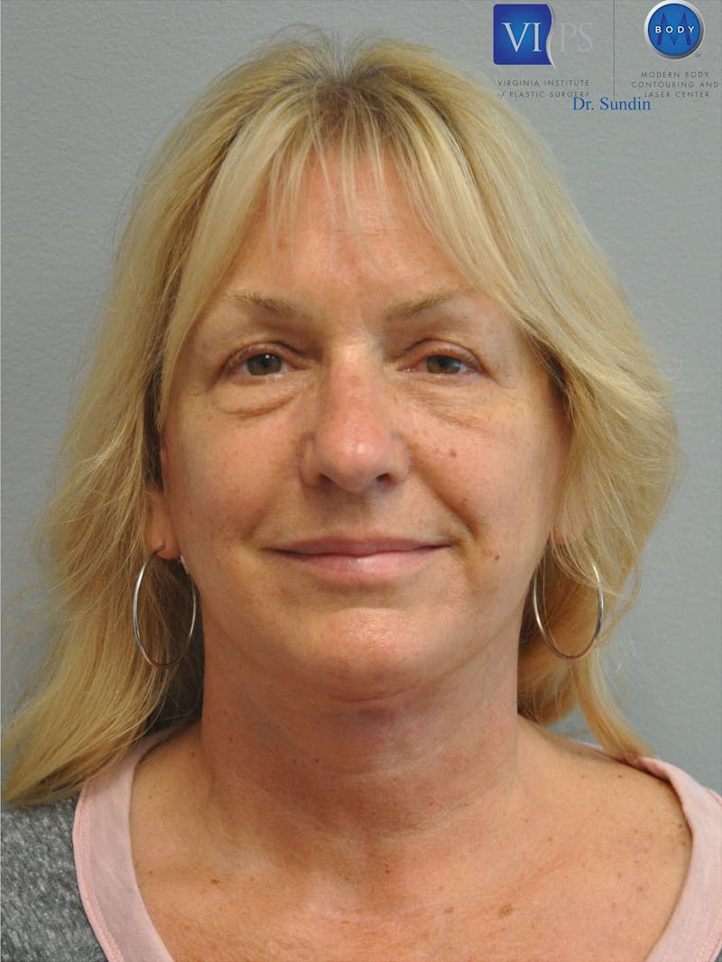 Facelift Before & After Gallery - Patient 201181556 - Image 2
