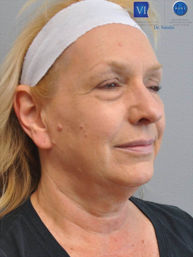 Facelift Before & After Gallery - Patient 201181556 - Image 3