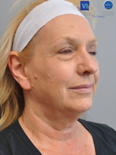 Neck Lift Before & After Gallery - Patient 201181563 - Image 1