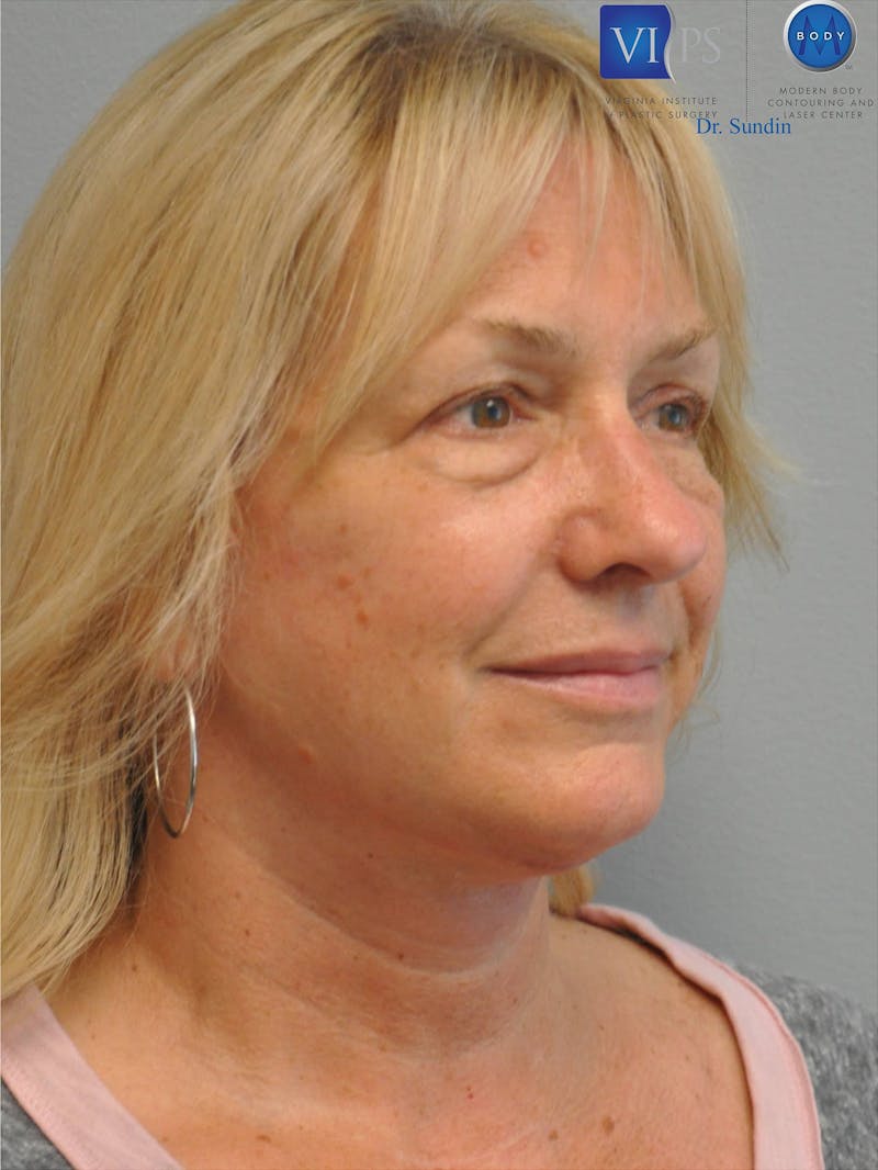 Facelift Before & After Gallery - Patient 201181556 - Image 4