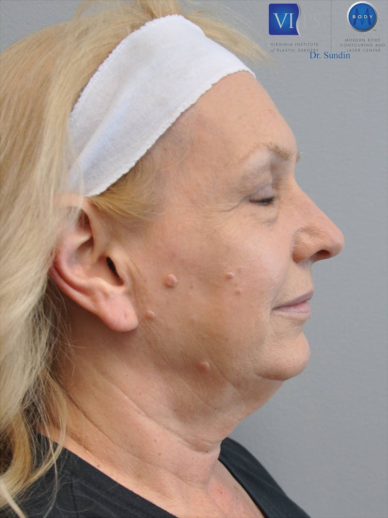 Facelift Before & After Gallery - Patient 201181556 - Image 5